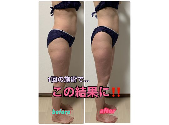 DETOCYCLE＆Si belles効果１