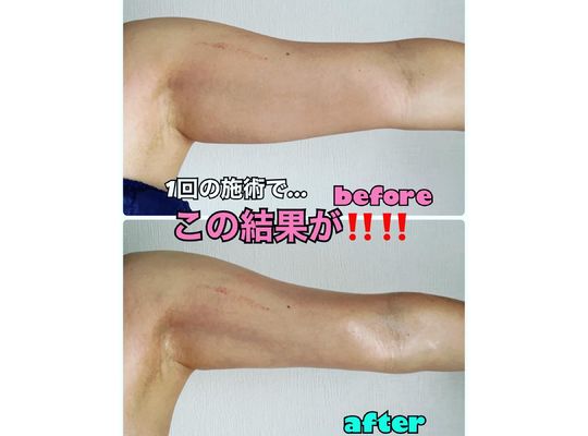 二の腕の変化すごい！