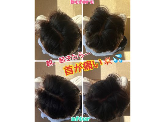 寝違いによる首痛改善